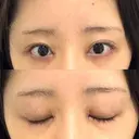 目頭切開 聖心美容クリニック 福岡院 DAY 7 サムネイル用