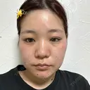 糸リフト / バッカルファット除去 / 脂肪吸引（顔） / ボトックス（口角） / ボトックス（首） アリエル美容クリニック 水戸院 DAY 37 サムネイル用