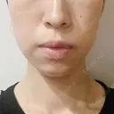 ハイフ（顔） A CLINIC（エークリニック） 大阪院 AFTER サムネイル用