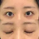 目頭切開 聖心美容クリニック 福岡院 DAY 8 サムネイル用