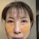 クマ治療 NARU Beauty Clinic 【ナルクリ】 DAY 5 サムネイル用