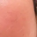 エレクトロポレーション G MEDICAL ART クリニック 表参道院 AFTER サムネイル用