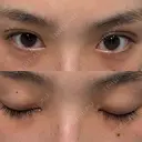 二重埋没 / 目頭切開 / 上まぶたの脂肪取り アリエル美容クリニック 郡山院 DAY 96 サムネイル用