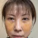 クマ治療 NARU Beauty Clinic 【ナルクリ】 DAY 6 サムネイル用