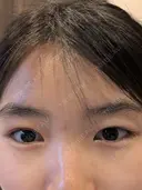眼瞼下垂（切開） BIANCA銀座 AFTER サムネイル用