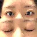 目頭切開 聖心美容クリニック 福岡院 DAY 10 サムネイル用