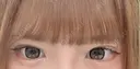 二重埋没 / 上まぶたの脂肪取り アリエル美容クリニック 郡山院 AFTER サムネイル用