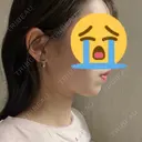 ハイフ（顔） HINATA クリニック DAY 1 サムネイル用