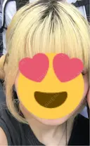 脂肪吸引（顔） R Beauty CLINIC 銀座院 AFTER サムネイル用