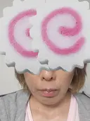 糸リフト / その他（輪郭） アリエル美容クリニック 水戸院 DAY 6 サムネイル用
