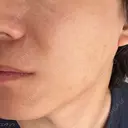 糸リフト ノア美容クリニック 飯田橋院 DAY 0 サムネイル用