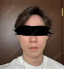 糸リフト / 脂肪吸引（顔） / ジョールファット除去 アリエル美容クリニック 郡山院 AFTER サムネイル用