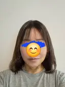 その他（輪郭） / ボトックス（エラ・小顔） / ボトックス（額） WOM CLINIC GINZA （ワム クリニック ギンザ） DAY 6 サムネイル用