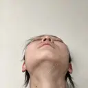 鼻尖形成（切開） / 小鼻縮小（切開） / 軟骨移植 / 鼻尖縮小 / 鼻孔縁下降 アリエル美容クリニック 郡山院 DAY 28 サムネイル用