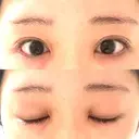 目頭切開 聖心美容クリニック 福岡院 DAY 13 サムネイル用