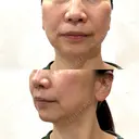 ハイフ（顔） / ボルニューマ LIFE LAB CLINIC DAY 19 サムネイル用
