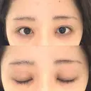 目頭切開 聖心美容クリニック 福岡院 AFTER サムネイル用
