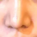 目頭切開 / 鼻尖形成（切開） / 軟骨移植 R Beauty CLINIC 銀座院 DAY 45 サムネイル用