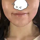 インモード PureMe Skin Clinic（ピュアミースキンクリニック麻布） AFTER サムネイル用