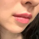 ヒアルロン酸注入（唇） PRO CLINIC プロクリニック 銀座院 DAY 0 サムネイル用
