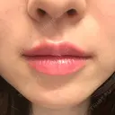 ヒアルロン酸注入（唇） PRO CLINIC プロクリニック 銀座院 AFTER サムネイル用