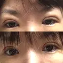 二重切開 / 上まぶたの脂肪取り 樹のひかり 形成外科・皮ふ科 DAY 4 サムネイル用