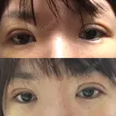 二重切開 / 上まぶたの脂肪取り 樹のひかり 形成外科・皮ふ科 DAY 5 サムネイル用