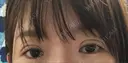 二重切開 / 上まぶたの脂肪取り 樹のひかり 形成外科・皮ふ科 DAY 8 サムネイル用