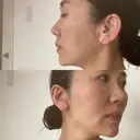 糸リフト / クマ治療 / バッカルファット除去 / ボトックス（エラ・小顔） / スネコス 札幌美容外科ネビュラクリニック DAY 43 サムネイル用