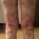 脂肪吸引（脚） Lipo Clinic omotesando DAY 7 サムネイル用