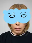糸リフト / その他（輪郭） アリエル美容クリニック 水戸院 DAY 14 サムネイル用