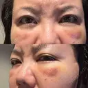 クマ治療 PRISM Beauty Clinic 町田院 DAY 7 サムネイル用