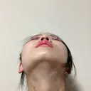 鼻尖形成（切開） / 小鼻縮小（切開） / 軟骨移植 / 鼻尖縮小 / 鼻孔縁下降 アリエル美容クリニック 郡山院 DAY 35 サムネイル用