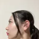 鼻尖形成（切開） / 小鼻縮小（切開） / 軟骨移植 / 鼻尖縮小 / 鼻孔縁下降 アリエル美容クリニック 郡山院 DAY 35 サムネイル用