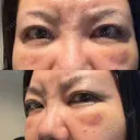 クマ治療 PRISM Beauty Clinic 町田院 DAY 8 サムネイル用