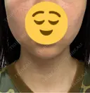 脂肪吸引（顔） / ジョールファット除去 / ボトックス（あご） / ヒアルロン酸注入（あご） / ボトックス（首） WOM CLINIC GINZA （ワム クリニック ギンザ） DAY 19 サムネイル用
