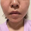 鼻翼基部形成（貴族手術） eクリニック 名古屋院 DAY 10 サムネイル用