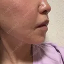 鼻翼基部形成（貴族手術） eクリニック 名古屋院 DAY 10 サムネイル用