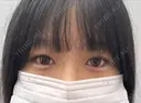 ヒアルロン酸注入（涙袋） / ボトックス（あご） / ボトックス（エラ・小顔） フィラークリニック 名古屋栄院 AFTER サムネイル用