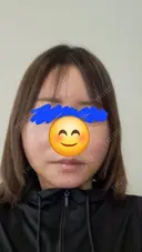 その他（輪郭） / ボトックス（エラ・小顔） / ボトックス（額） WOM CLINIC GINZA （ワム クリニック ギンザ） DAY 7 サムネイル用