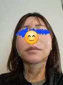 その他（輪郭） / ボトックス（エラ・小顔） / ボトックス（額） WOM CLINIC GINZA （ワム クリニック ギンザ） DAY 7 サムネイル用