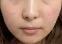 その他（輪郭） / 医療痩身（顔） / その他（肌） / RF（高周波）たるみ治療 / オンダリフト ライブリークリニック 船橋院 DAY 1 サムネイル用