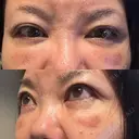 クマ治療 PRISM Beauty Clinic 町田院 DAY 9 サムネイル用