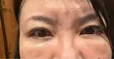 クマ治療 PRISM Beauty Clinic 町田院 DAY 9 サムネイル用