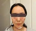 糸リフト / 脂肪吸引（顔） / メーラーファット除去 / 脂肪吸引注射（顔） SEA CLINIC（シークリニック） AFTER サムネイル用