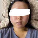 糸リフト / バッカルファット除去 / 脂肪吸引（顔） / ネックリフト / ヒアルロン酸注入（あご） / ボトックス（エラ・小顔） / ヒアルロン酸注入（唇） / ヒアルロン酸注入（鼻翼基部） / ヒアルロン酸注入（ほうれい線） HAAB×DREAM BEAUTY CLINIC 東京本院 DAY 2 サムネイル用