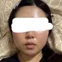 糸リフト / バッカルファット除去 / 脂肪吸引（顔） / ネックリフト / ヒアルロン酸注入（あご） / ボトックス（エラ・小顔） / ヒアルロン酸注入（唇） / ヒアルロン酸注入（鼻翼基部） / ヒアルロン酸注入（ほうれい線） HAAB×DREAM BEAUTY CLINIC 東京本院 DAY 7 サムネイル用