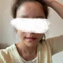 脂肪注入（額） 4Dクリニック AFTER サムネイル用