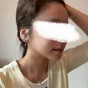 脂肪注入（額） 4Dクリニック DAY 28 サムネイル用