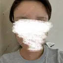 脂肪注入（額） 4Dクリニック DAY 3 サムネイル用